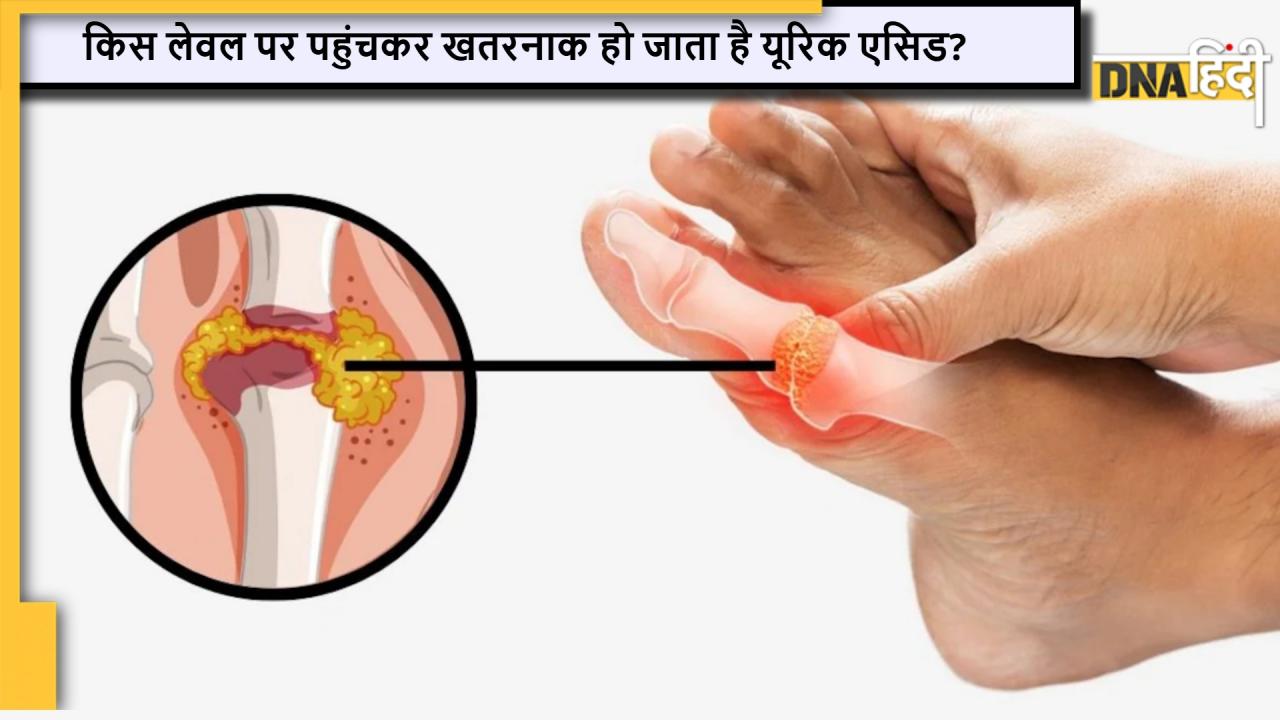 Uric Acid Level: नॉर्मल से बाहर, जानें किस लेवल पर पहुंचकर खतरनाक हो जाता है यूरिक एसिड?