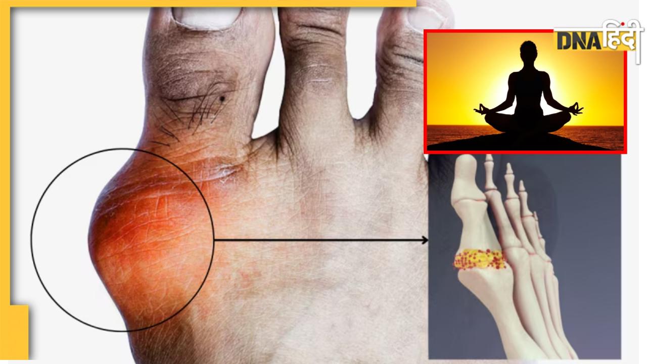 3 Exercises, जो 3 महीने में शरीर से निचोड़ देंगे यूरिक एसिड, 7 mg/dL से भी हाई लेवल होगा नार्मल