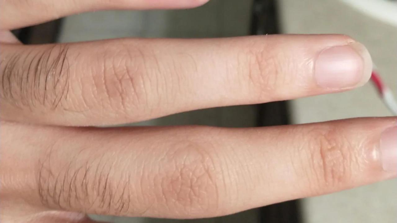 उंगलियों पर कम या न के बराबर बाल