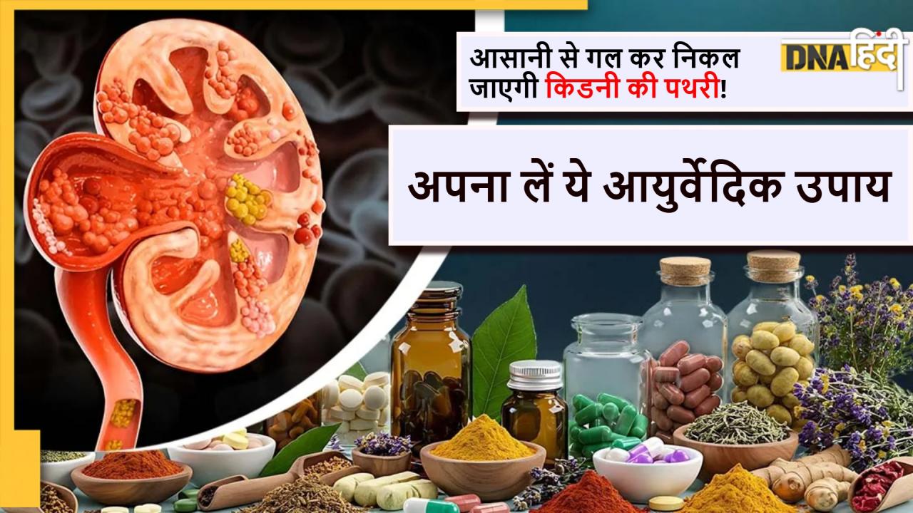 Kidney Stone Remedy: पता भी नहीं चलेगा, गल कर निकल जाएगी किडनी की पथरी! बस अपना लें ये आयुर्वेदिक उपाय