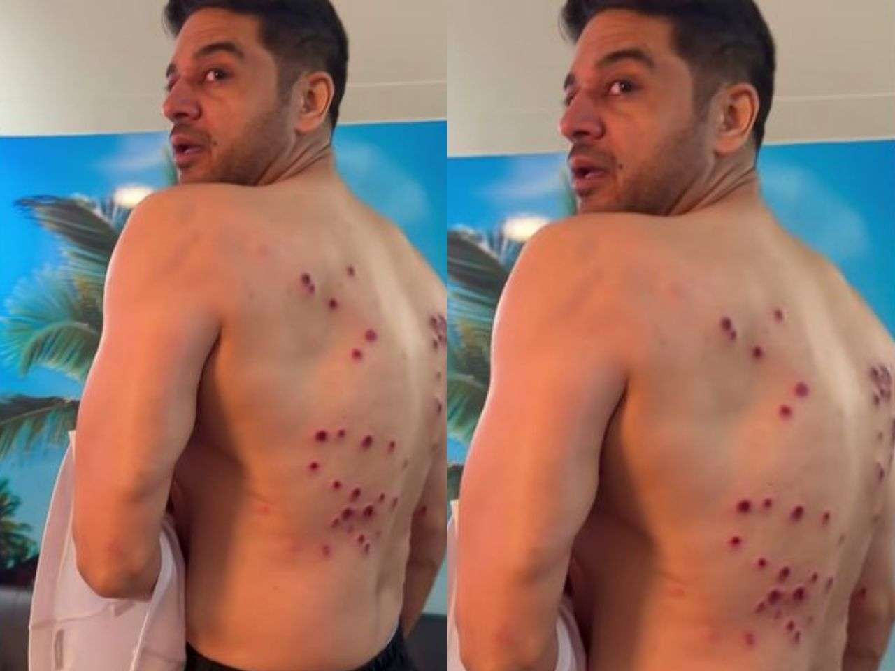 Amid divorce buzz, Gaurav Khanna suffers 'most painful' experience, suffers burns due to..., admits 'still have these marks'