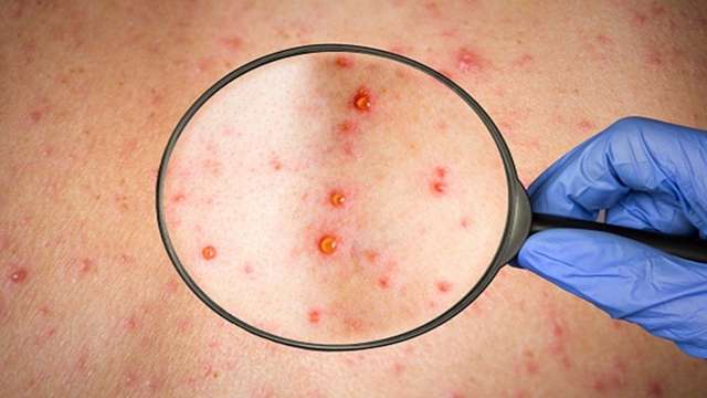 WHO warns monkeypox virus spreading in sexual networks, know causes and symptoms - Vimarsana News