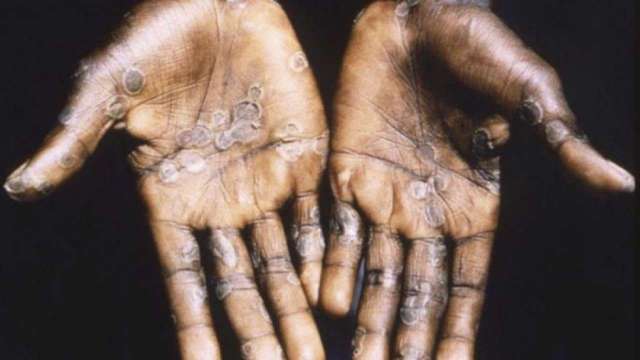 Monkeypox: ICMR urges people to seek medical help if they have THESE symptoms - Vimarsana News