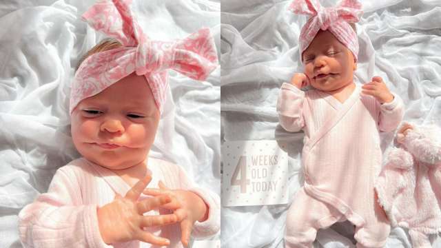 'Permanent smile' baby born in Australia with 'bilateral microstomia', know more about the rare condition - Vimarsana News