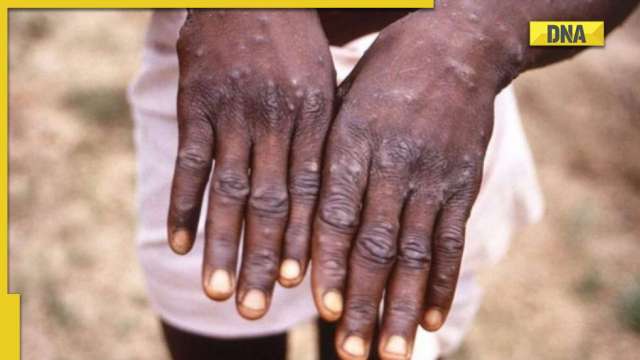 Monkeypox: 'Unnecessary panic mongering,' says government after sample of suspected case in UP sent for testing - Vimarsana News
