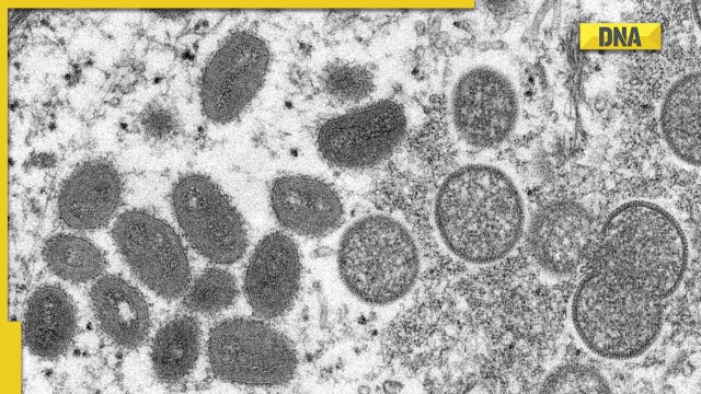 Monkeypox scare: 77 new cases reported in UK, largest spread outside Africa - Vimarsana News