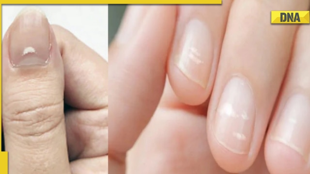 No half-moon on nails: What does it mean?
