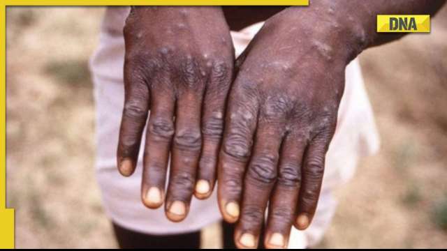 Monkeypox presently not a global health emergency, but an evolving threat: WHO - Vimarsana News