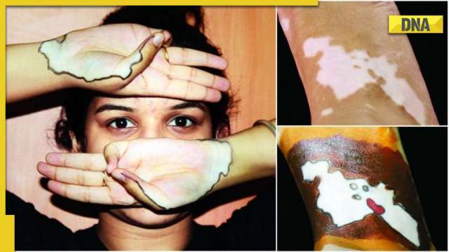 Impacts of vitiligo on mental and physical health