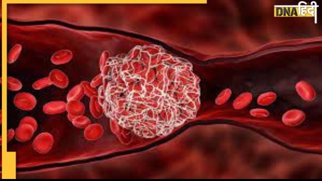 blood clot causes high bp