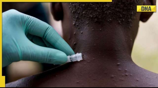 Second case of monkeypox reported in Kerala's Kannur district - Vimarsana News