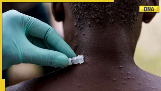 Monkeypox declared global health emergency: Know about the rare disease, its symptoms and cure - Vimarsana News