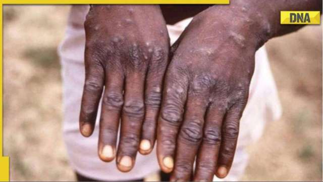 Monkeypox spread not restricted to LGBTQ community, experts confirm - Vimarsana News