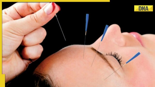 Can acupuncture therapy be helpful in fighting off diabetes? - Vimarsana News
