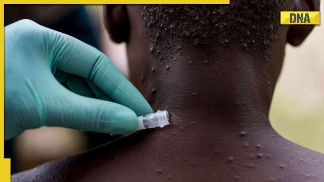 Monkeypox outbreak in India: With 8 cases and 1 death in country, here's what Health Ministry said - Vimarsana News