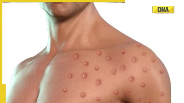 Monkeypox A.2 strain found in India: Symptoms and all you need to know - Vimarsana News
