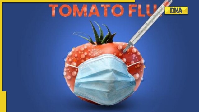 Tomato Flu In India: Check Symptoms, Treatment Of Rare Disease ...