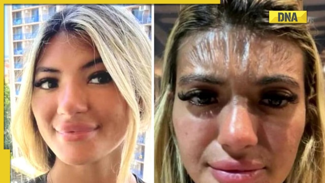 Woman who fell asleep in sun for 30 minutes wakes up with a 'plastic' forehead - Vimarsana News