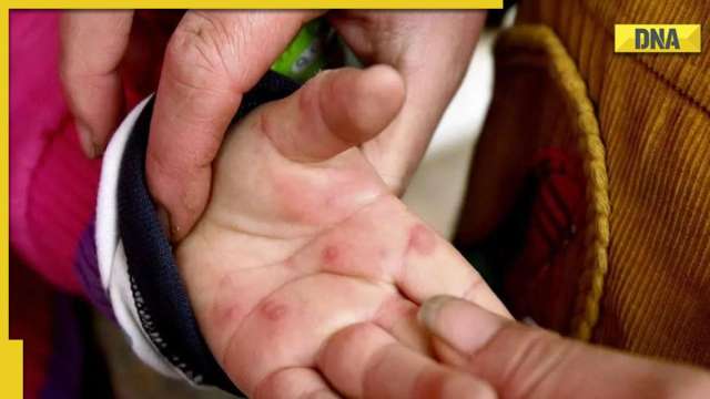 Tomato flu not related to Covid, monkeypox, other viral infections, says Centre: 5 things you must know - Vimarsana News