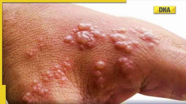 Monkeypox: Major drop in cases globally, outbreak headed towards decline, says WHO - Vimarsana News