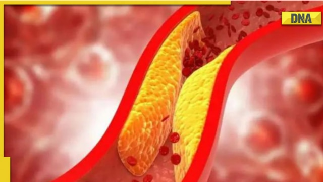 high-cholesterol-treatment-know-5-natural-ways-to-lower-cholesterol-levels