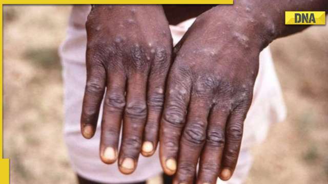 Monkeypox A.2 lineage mutating in India, ICMR study finds 3 sub-clusters - Vimarsana News