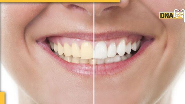 yellow teeth home remedies 