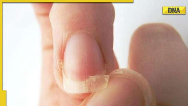 Vitamin B12 deficiency: Signs of vitamin deficiency in nails | HealthShots