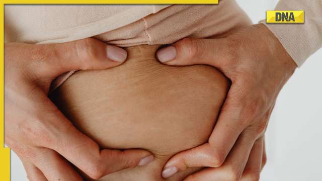 DIY: How to reduce stretch marks? - Vimarsana News