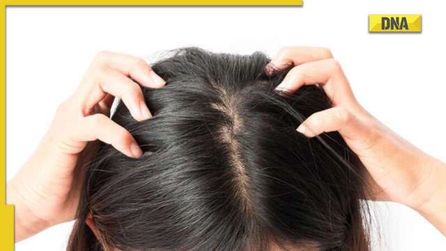 Home remedies for dandruff in winters, check out these useful tips - Vimarsana News
