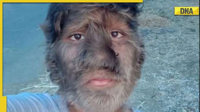 Madhya Pradesh: Teenager suffering from rare 'werewolf syndrome' speaks up on getting bullied at school - Vimarsana News