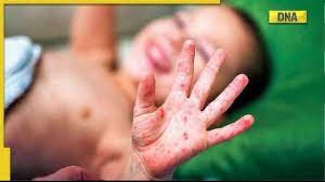 measles-claims-life-of-second-child-in-two-days-8-month-old-dies-in