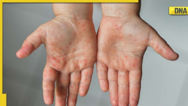 Measles outbreak in Mumbai: Know the best way to prevent yourself from measles - Vimarsana News