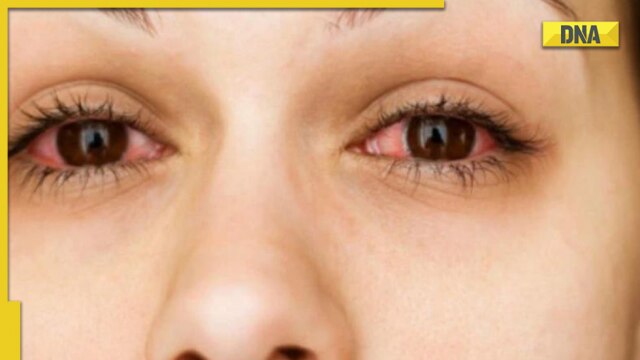 Red and itchy eyes? Here are some ways to protect your eyes from polluted air - Vimarsana News