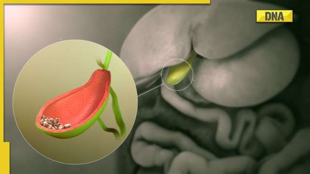 What diet to follow after gallbladder removal? - Vimarsana News
