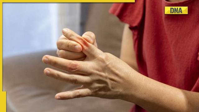 Uric Acid: List of foods that should be avoided to reduce joint pain during winter - Vimarsana News