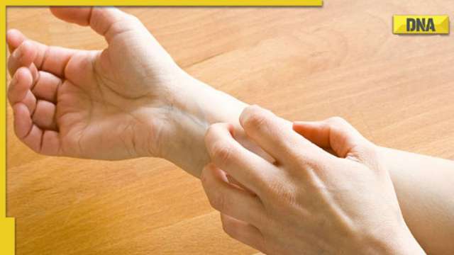 Distinguishing different types of dermatitis: Symptoms, causes, and effective treatment options - Vimarsana News