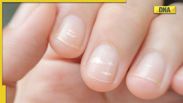 What's the effect of a white spot on the surface of a nail? - Quora