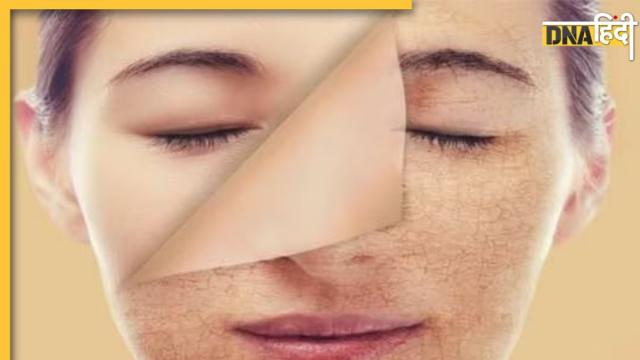 Home Remedies For Pigmentation