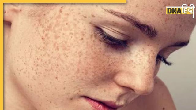 Hyperpigmentation Treatment