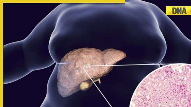 Can fatty liver lead to colon cancer? Here's what new study shows - Vimarsana News