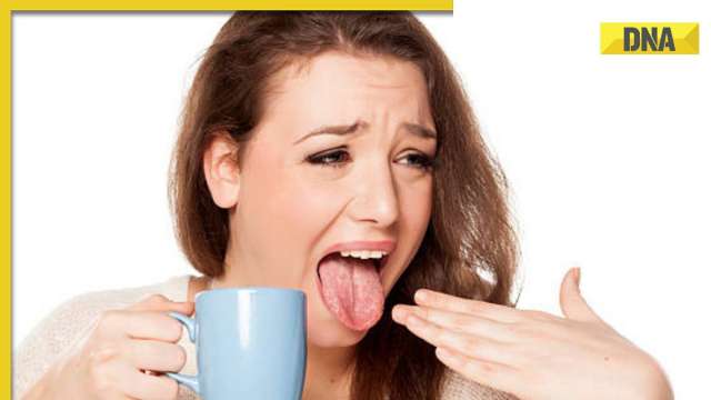 Got your tongue burnt? 5 tips for quick relief - Vimarsana News