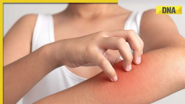 5 effective tips to prevent fungal infections during monsoon - Vimarsana News