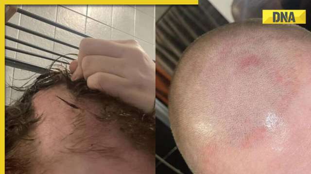 UK woman claims botched hair extensions left her bald; here's how can you protect your hair - Vimarsana News