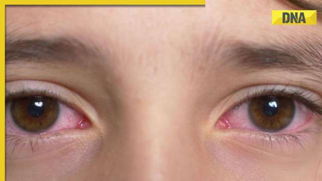 Conjunctivitis alert: How to protect your school-going child from eye infection? - Vimarsana News