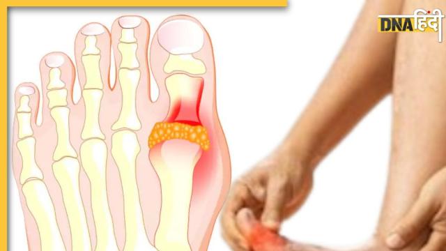 Uric Acid Treatment 