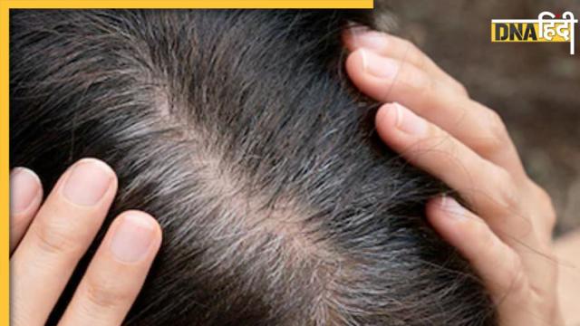 White Hair Remedies