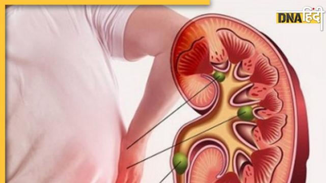 Kidney Stone