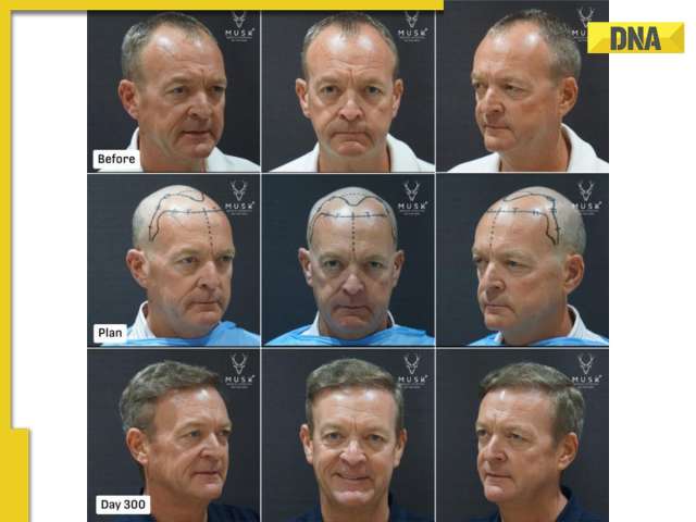 dnaindia.com - DNA Web Team - India's Medical Tourism Boom: How Musk Clinic is shaping global aesthetics & hair restoration demand