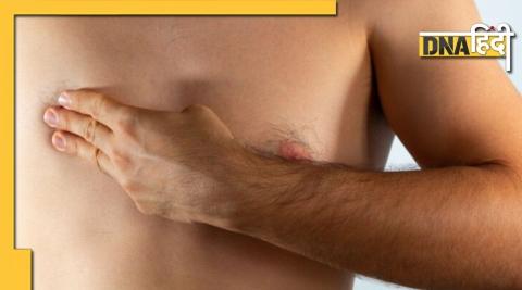 Breast cancer in males